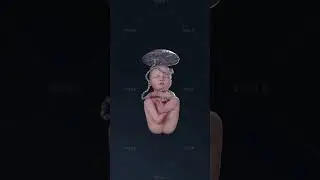 Qu&rsquo;est-ce que la pr&eacute;sentation du si&egrave;ge mixte et pourquoi la c&eacute;sarienne est-elle recommand&eacute;e ? en 3D