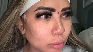 || LUNCHTIME FACELIFT || PDO THREAD LIFT ||
