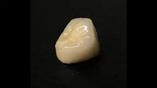 CORONA metal-porcelana? (laboratorio dental)