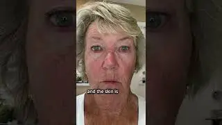 ✨ Fractional CO2 Laser with Dr. Tzikas | Faster Healing, Smoother Skin ✨