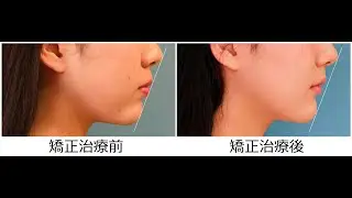 19歳 女性｛ 過去の矯正の 再治療 ｝「口もとを 下げたい」治療期間19か月