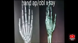 hand x-ray  ap /obl position me kese karte h ( full information in hindi )
