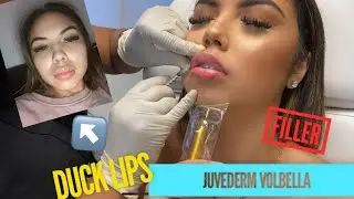 LIP FILLER EXPERIENCE ! Juvederm Volbella - Before & after! @injectorkim