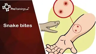 Snake Bites
