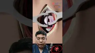 What is Tracheostomy? #doctor #3danimationsurgery #medicalanimation #trachea #animation