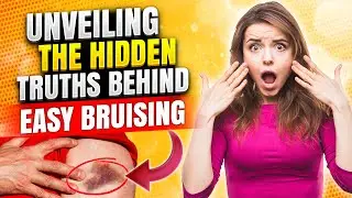 🤔DO YOU BRUISE EASILY? Uncover the Secrets to Preventing Bruising Naturally! ✨🩹 #PreventBruising