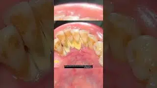#tooth stains