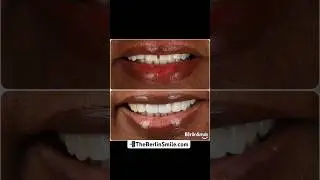 The results speak for itself 🔥 #shorts #dallas #texas #smile #influencer #veneers #dentist #tiktok