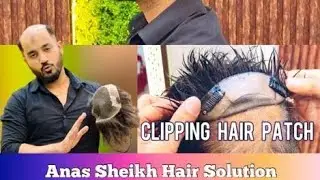 clipping hair patch system | clipping hair patch | clipping hair patch review | call us 9650914665