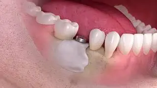 Kaulo augmentacija ir implantavimas - Straumann&reg;