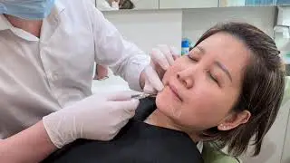 Marionette Lines Filler