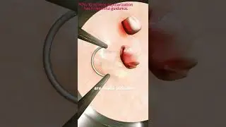Bladder cancer treatment options (3D animation) #3danimation #motivation #motivation #science
