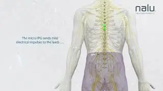 How SCS Works   Nalu Patient Animation MKT 320011 Rev A