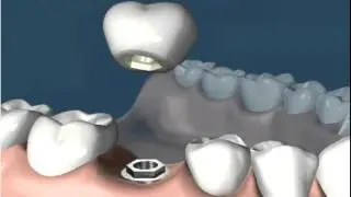 Dental Implants Single Tooth 1