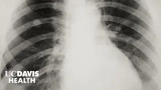 Lung Cancer in Asian American Women Who Never Smoked - The FANS Study at UC Davis