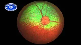 SARDS (Sudden Acquired Retinal Degeneration Syndrome)