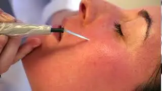 Broken Blood Vessel Removal