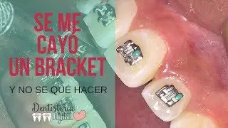 SE ME CAYÓ UN BRACKET y no se qué hacer!