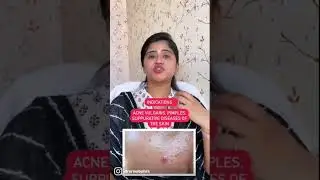 Best Homeopathic Medicine for Acne and Pimples #shorts #youtubeshorts
