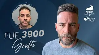 Before & After: 3900 Grafts FUE Journey | 3, 6 & 9-Month