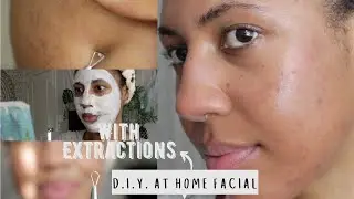 HOW TO: DIY AT HOME FACIAL FOR CLEAR SKIN (Includes Extractions) | ADULT CYSTIC ACNE