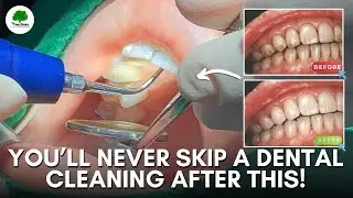 Why Dental Cleaning is More Than Just a Smile | Oaks Dental Clinic
