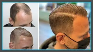 Haartransplantation T&uuml;rkei ✅ VORHER - NACHHER mit 3750 Grafts | Health Travels [Dr. G&ouml;khan G&uuml;r]