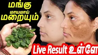 Mangu maru will disappear overnight mangu maraya tips in tamil#pigmentation #beautytipsintamil #d...