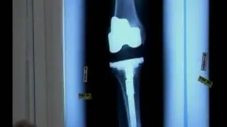 Case History - Total Knee Revision