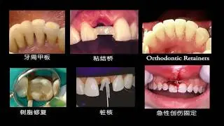 Ribbond Training Video - Chinese Text and Titles