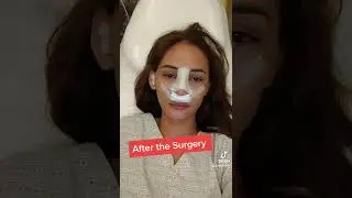 The day before rhinoplasty in the Philippines #rhinoplasty  #philippines #fypシ
