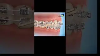 Damon Braces: How Self-Ligating Brackets Transform Orthodontics! #orthodontics#orthodontist #damon
