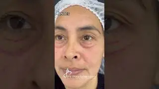 Blefaroplastia inferior ✂️ #blefaroplastia #ojeras #bolsas #mirada #antesydespues #cirugiaplastica