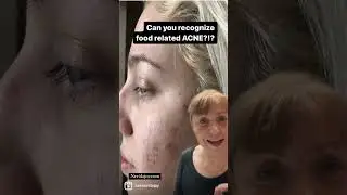 Food related ACNE