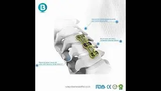 Anterior Cervical Plate | Cervical Spine Fixation System | Biomedortho