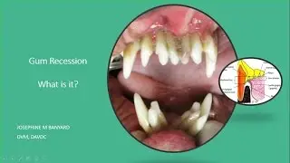 Gum Recession - What is it