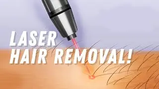 Does Laser Hair Removal Work on  BLACK Skin? Expert Advice from a Hair Removal Pro!