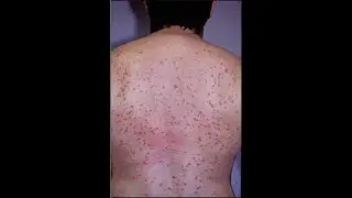 Acneiform eruptions (skin conditions that resemble acne Pimples) ; Causes, Symptoms, Treatment