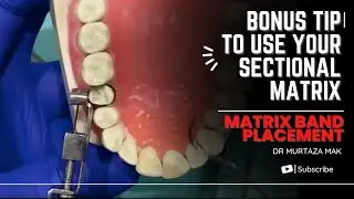 Matrix band placement- Bonus tip to use your sectional matrix