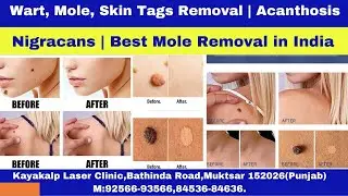 Wart, Mole, Skin Tags Removal | Acanthosis Nigracans | Best Mole Removal in India
