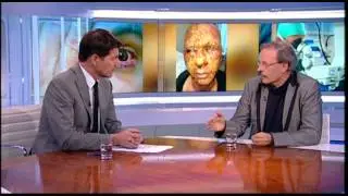 Reportage Nieuwsuur over vuurwerkslachtoffers in Het Oogziekenhuis Rotterdam 2/2/2015