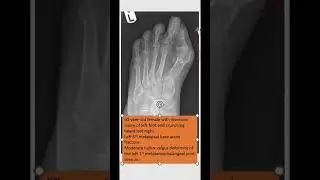 metatarsal base fracture with hallux valgus deformity