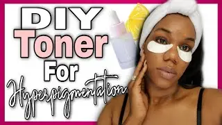 BEST DIY Toner For Hyperpigmentation! How To Fade Dark Acne Spots