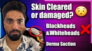 Remove Blackheads and Whiteheads In 5 Minutes | Derma Suction Ke Side Effects | Get Clear Skin