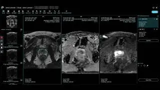 Ezra FDA-cleared Prostate AI PACS