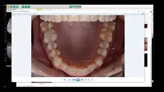 Endodontic Diagnosis Patient 14