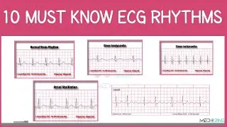 Top 10 MUST-KNOW Electrocardiogram (ECG) Rhythms Simplified! | ECG Interpretation Made Easy