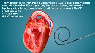 Introducing the Wattson&trade; Temporary Pacing Guidewire