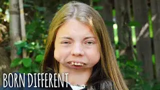 I Was Born Without A Jaw | BORN DIFFERENT