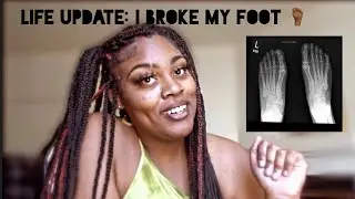 | Chit Chat | I Broke my foot!